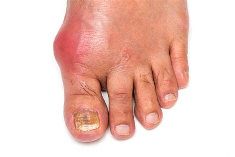 Big Toe Inflammation