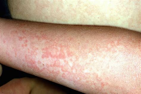 Fifth Virus Rash