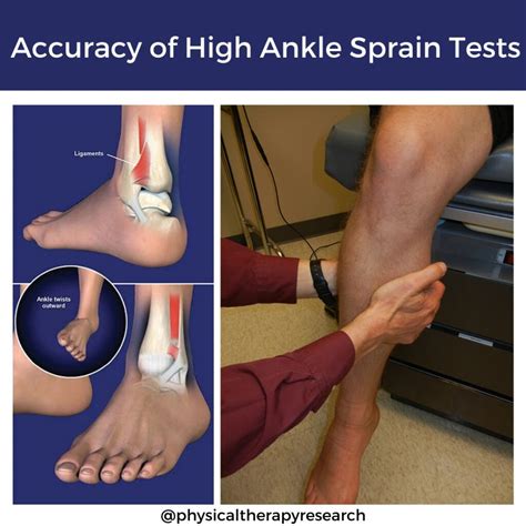 Are High Ankle Sprain Tests Accurate? - Physical Therapy Research