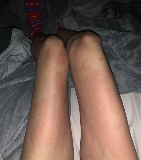 How do I avoid oral antihistamines prior to skin prick test?? : r/urticaria