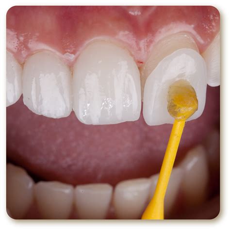 5 Dental Procedures to Repair Your Cracked or Broken Tooth