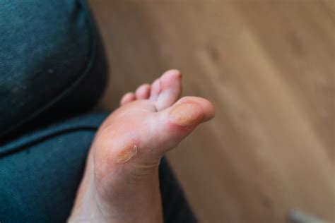 Paronychia Symptom, Causes and Podiatric Treatment