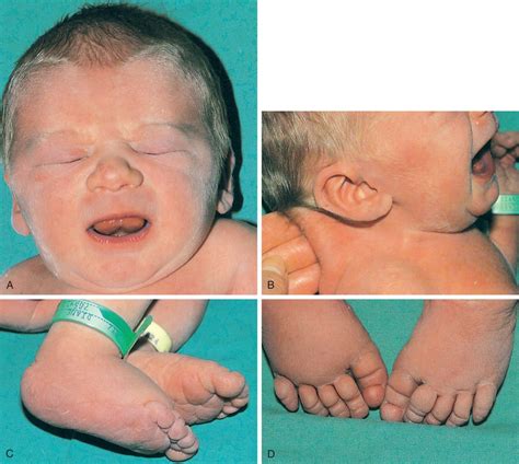 Human Birth Defects - Clinical Tree