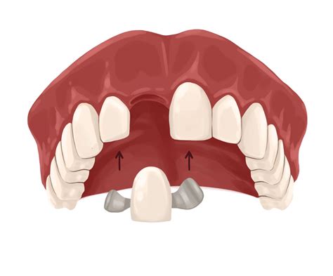 Dental bridge: types, and procedure | Authority Dental