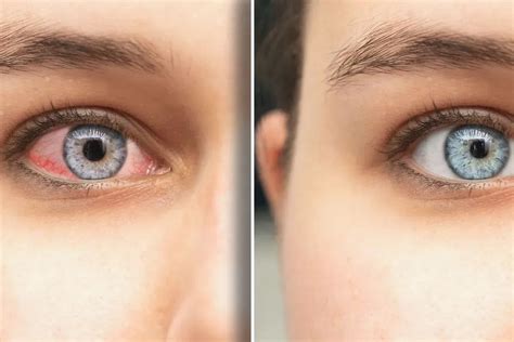 How to Relieve Eye Pain: Best Drops & Relief Methods