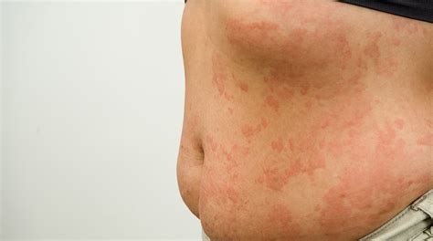 Cold Urticaria Hives Treatment at Elmo Reeves blog