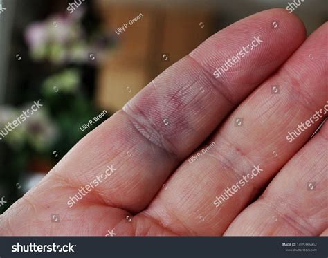 Burst Blood Vessel In Finger Images Blood Blisters: Causes, Diagnosis,