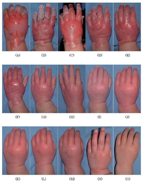 Third Degree Burn Healing