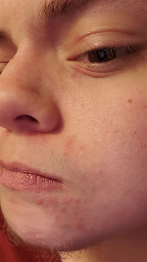 (Details Below)What is this Facial Rash?? Blistering&Dry&Painful : r ...