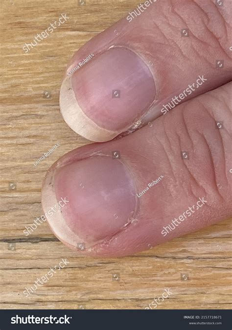 102 빈혈 손톱 Images, Stock Photos & Vectors | Shutterstock