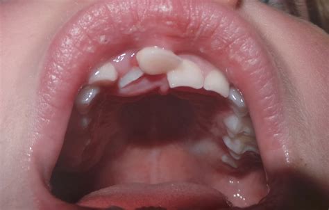 RELENTLESS: How To Get Rid of an Unwanted Wobbly Tooth