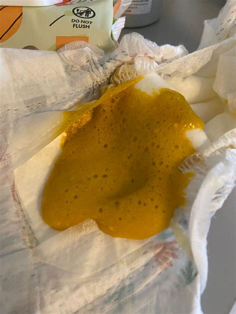 Foamy Poop Crohn's at Evelyn Shank blog