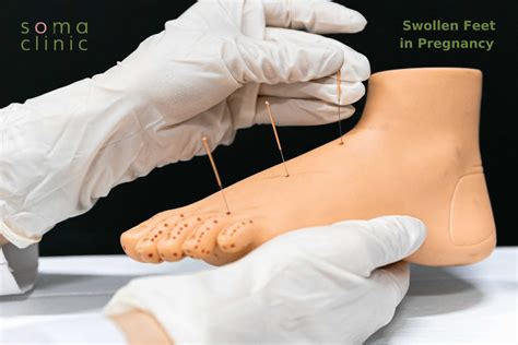 Pregnancy Water Retention - 7 Important Measures You Need