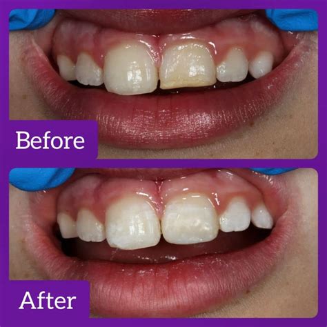 Composite Bonding Teeth Los Angeles at Keira Crampton blog