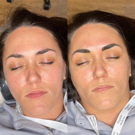 Nano vs Micro Needling — Renewed Skin and Body Spot