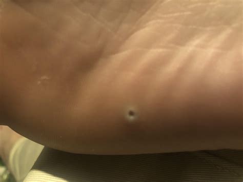 I have this hole in my foot and its been there for like a month now 16 ...