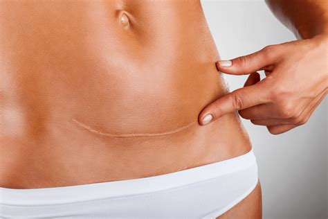 Can You Ever Get Rid Of C-Section Pouch? - Live Core Strong