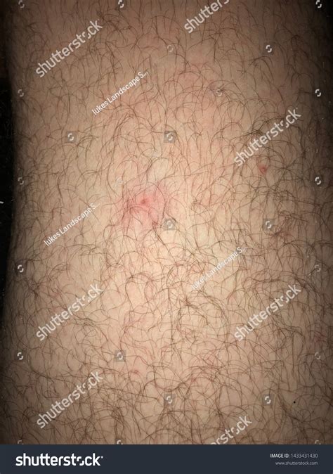 Pimple On Hairy Leg Hair Stock Photo 1433431430 | Shutterstock