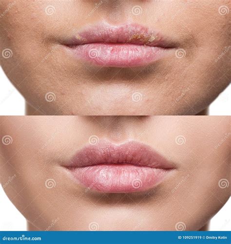 Herpes Lip Swelling Treatment at Amy Browning blog