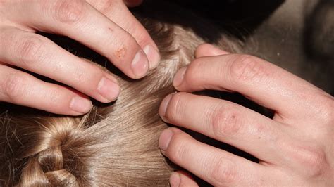 What Is Scalp Acne? How to Treat Pimples on Your Scalp | Allure