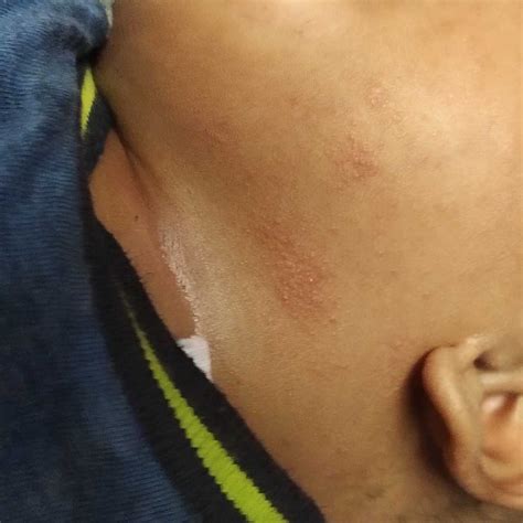 Red Spotty Rash On Baby Neck at Brianna Rocher blog