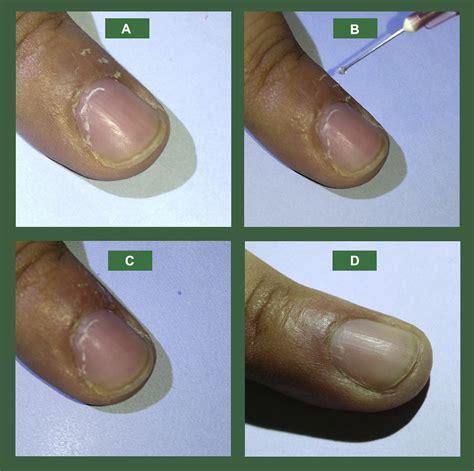 Hangnail: A simple solution to a common problem - Journal of the American Academy of Dermatology