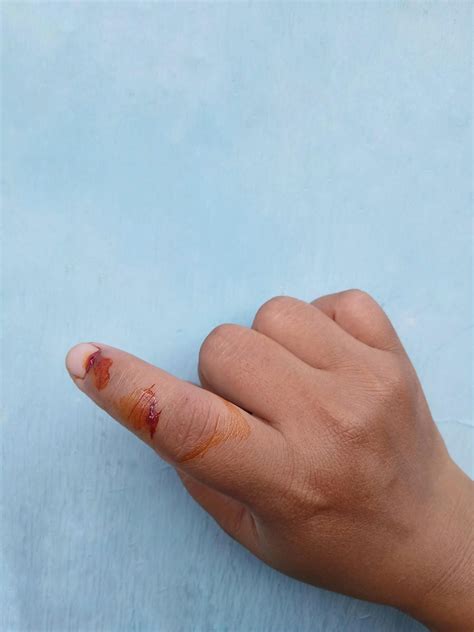 A dog bite wound and blood on hand. Infection and Rabies concept ...