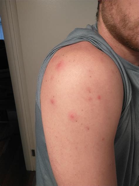 Constantly get big red, painful, puss/blood filled pimple like bumps on ...