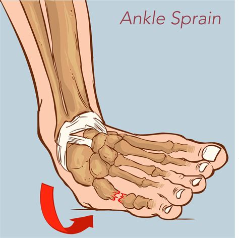 Ankle Inversion