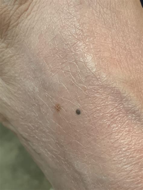 Small Black Dots On Skin