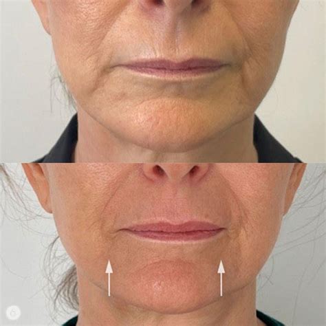 Marionette Lines Treating Marionette Lines Facial Acupuncture