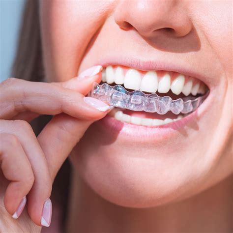 Different Types of Retainers to Wear After Houston Braces