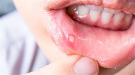 How to Make Cold Sore Heal Faster: Tips to Get Rid of Mouth Sores