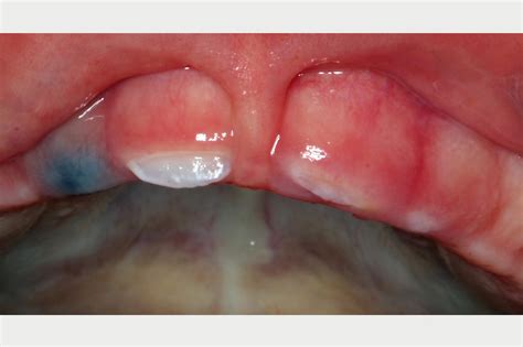 What Is A Dental Hematoma at Jody Featherston blog