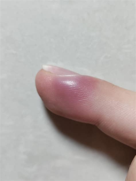 Infection in finger : r/medical