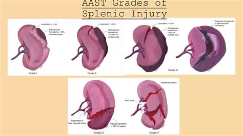 Splenic Laceration Grading