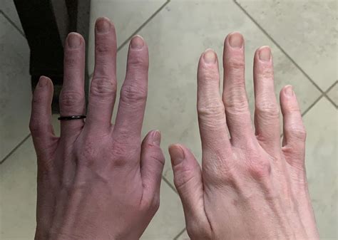 Pooling Blood In Hands