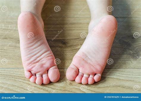 Enterovirus Feet Rash on the Body of a Child. Cocksackie Virus Rash ...