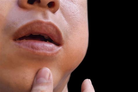 Parotitis: Parotid Gland Swelling Causes, Symptoms, Treatment