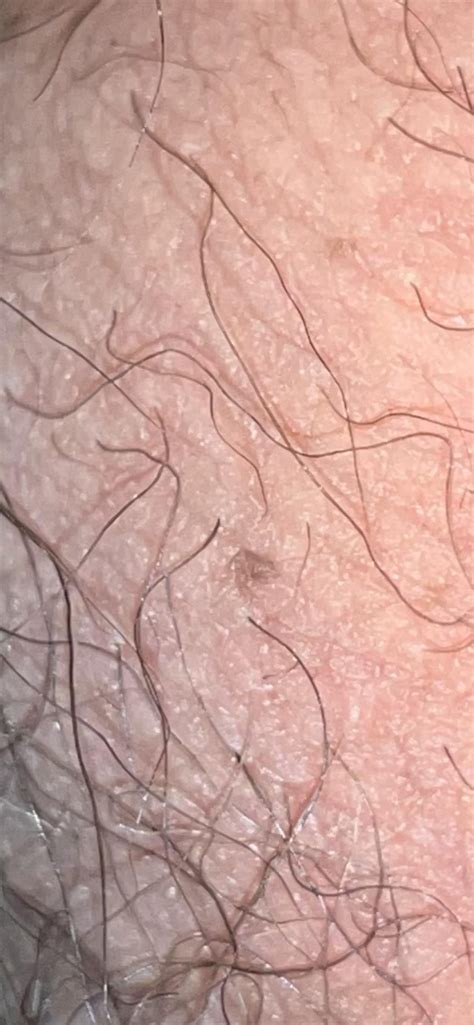 New dark spot on scrotum, is it cancer? : r/DermatologyQuestions