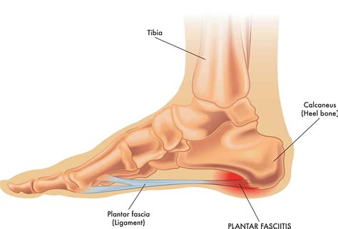 Heel Pain in the Morning: What Conditions cause Heel Pain