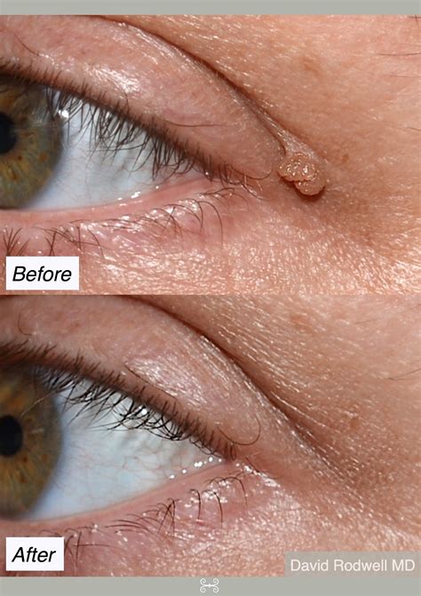 Skin Cancer Mole Chart / Skin Cancer | Everything Skin Clinic