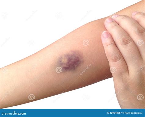 Blood Clot Bruise Pictures at Xavier Longman blog