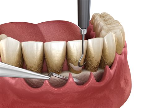 Periodontal Scaling and Root Planning Post-Op Instructions - Evelyn Ascough DDS