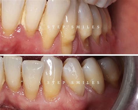 Gingival Graft Before And After Soft Tissue Grafting: What To Know