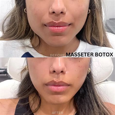 Masseter Botox Before and After - Before After Journey