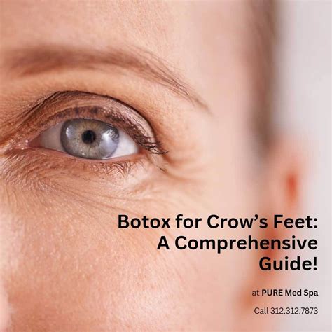 Botox for Crow’s Feet: A Comprehensive Guide! - PURE Medical Spa