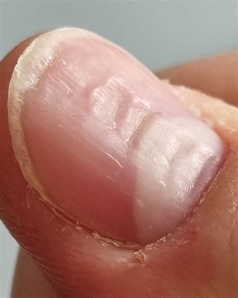 What Causes Horizontal Ridges In Fingernails