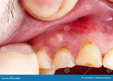 Inflammation of the Gums Abscess Closeup, Stock Photo - Image of ...
