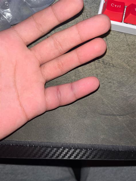 is my finger jammed or broken, : r/medical